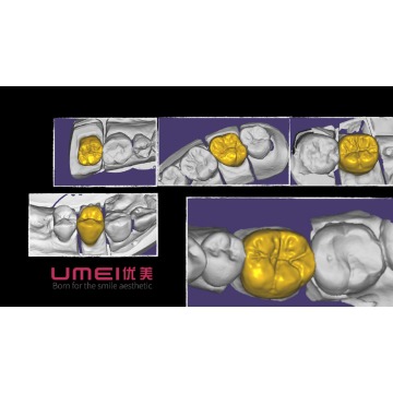 Cad Design On Personal Teeth